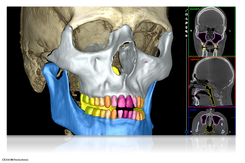 Planmeca introduces new AI-based tools for Planmeca Romexis®