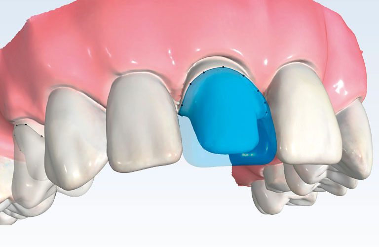 Logiciel CAD/CAM pour la dentisterie | Planmeca
